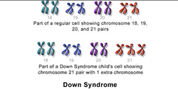 Types of Genetic Disorders - Human Genetic Disorders
